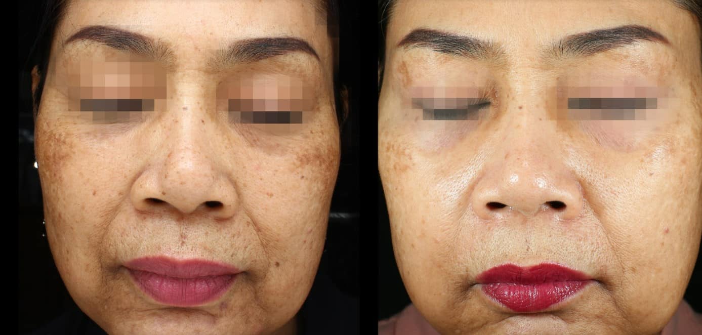 Westerville Melasma Treatment